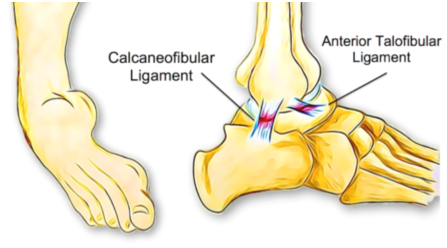ankle sprain treatment