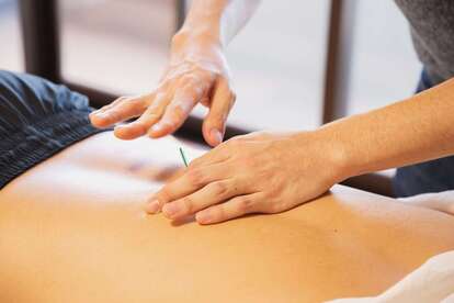 acupuncture dry needling