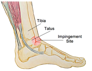 ankle impingement pain