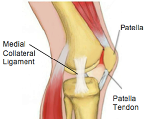 MCL knee injury