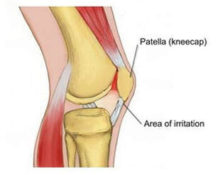 patellofemoral knee pain