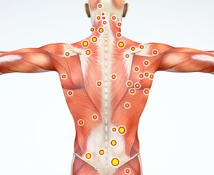 muscle trigger points