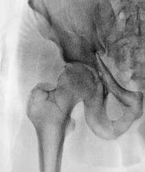 Hip Pain and Labral (Cartilage) Tears