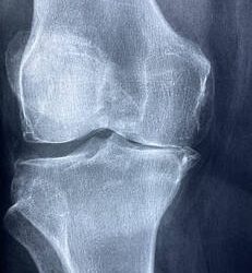 Osteoarthritis of the Knee